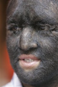 sindrome-do-lobisomem-3